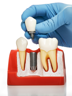 Dental Implants Markham