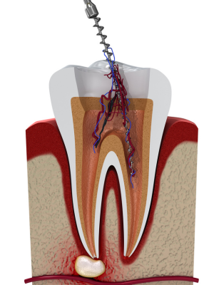 Root Canal Treatment Markham Dentist