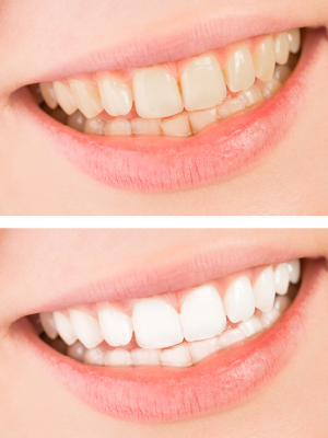 Teeth Whitening Markham Dentist